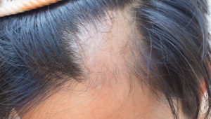 Queda de Cabelo: causas, prevenção e tratamento