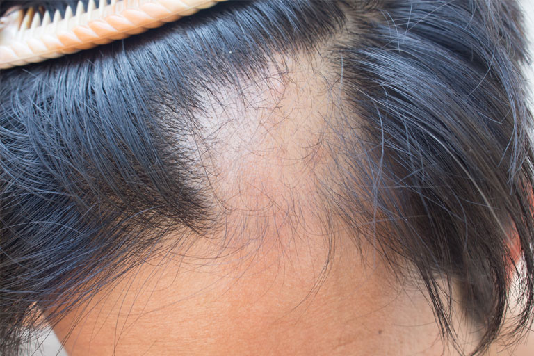 Queda de Cabelo: causas, prevenção e tratamento